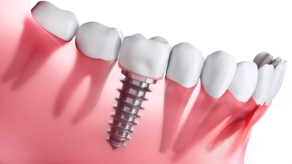 dental implants in NL