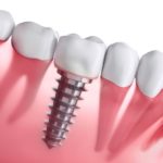 dental implants in NL